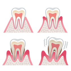 歯周病ってどんな病気なの？
